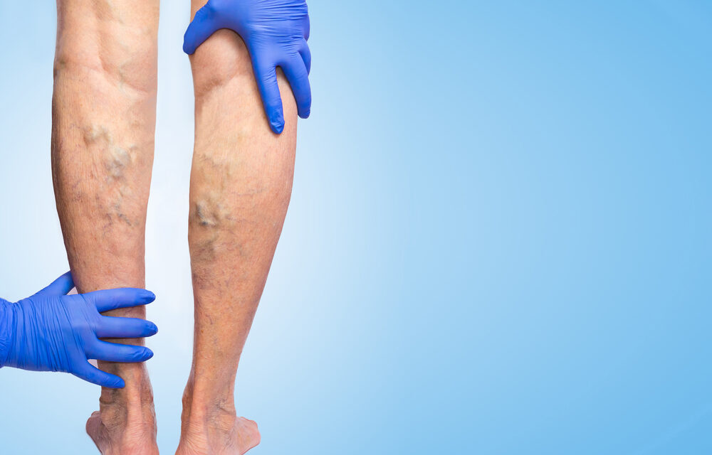 PRP for Chronic Venous Leg Ulcers