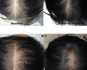 Platelet-Rich Plasma and Its Effectiveness in Hair Regrowth