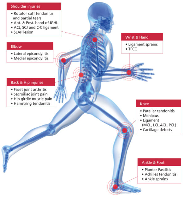 Orthopedic – PRP Therapy and Treatment | Platelet Rich Plasma | PRP Kits